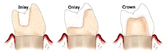 Unterschiede Inlay Onlay Teilkrone