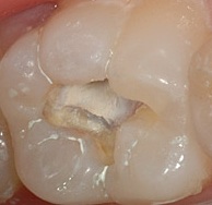 Zahnzement ist das ideale Material für zahlreiche Verwendungen im Dentalbereich. So eignet sich Zahnzement beispielsweise als provisorische Zahnfüllung bei tiefer Karies.