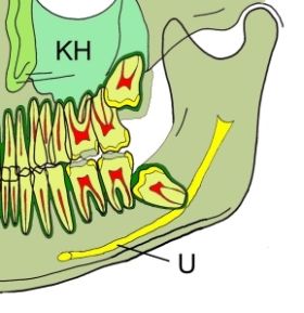 Die Entfernung des Weisheitszahns ist ein routinemäßiger Engriff der Oralchirurgie.