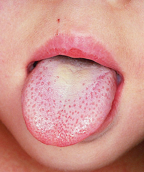 Pilzinfektion Im Mund Symptome Fur Einen Mundpilz Auf Der Zunge.