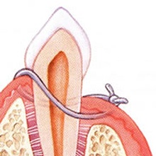 Die Parodontaloperation wird mit einem Wundverschluss abgeschlossen.