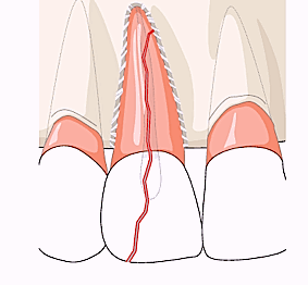 Wurzelfraktur des Zahns