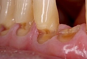Die ZAhnerosion wird durch zu starkes Zähneputzen oder das beständige Trinken säurehaltiger Getränke intensiviert, so können auch freiliegende Zahnhälse entstehen.