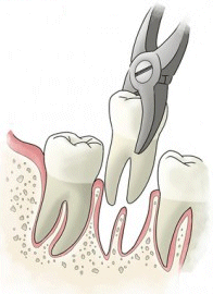 Zahnextraktion von einem kaputten Zahn