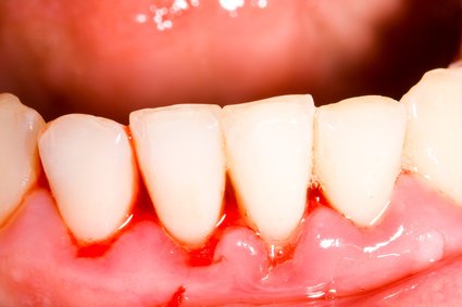 Die Zahnfleischentzündung (Gingivitis) kann ein Auslöser sein