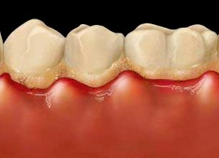 Zahnfleischentzündung und Plaqueanlagerung