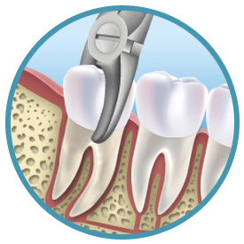 Ablauf einer Zahnoperation