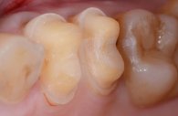 Zahnpräparation für Cerec-Krone