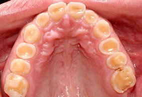 Abradierte Zähne durch Bruxismus