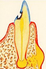 Eiterbildung durch entzündeten Zahn