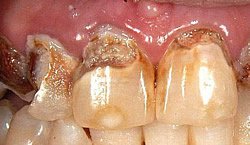 Die Angst wächst, umso länger der Patient nicht in Behandlung geht und umso tiefer die Schäden an den Zähnen werden.