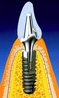 Wird ein Implantat trotz Parodontitis gesetzt, ist die besonders gründliche Pflege im Nachhinein besonders wichtig.