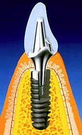 In der Zahnarztpraxis gibt es eine Reihe von alternativen Implantatsystemen, die für alle Beschaffenheiten im Kiefer geeignet sind.