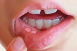 Allergien gegen Implantate können sich durch brennende Schleimhäute äußern, aber auch Aphten, Bläschen oder Zahnerosionen können die Folge einer Unverträglichkeit gegen einen Stoff im Zahnimplantat sein. 