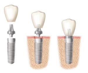 Implantate werden immer häufiger von Patienten als feste Alternative zum klassischen Zahnersatz gewählt. Hier ist die Stabilität sehr wichtig, die am Einheilungsprozess hängt. Ein Periotest kann diese Festigkeit testen.