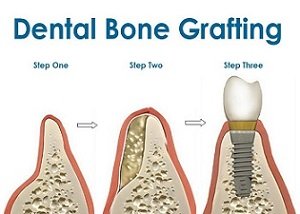 Zunächst wird, wenn nötig, vor einer Zahnimplantation eine Augmentation vorgenommen, die den Knochen aufbaut und die Basis bildet für die kommenden Implantate.