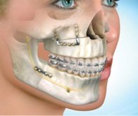 Der Zahnarzt kann Ihnen sagen, ob Fehlstellungen im Rachen oder Kiefer vorhanden sind. Er empfiehlt Ihnen den entsprechenden Spezialisten oder behandelt Kieferfehlstellungen, die das Schnarchen verursachen.