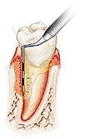 Parodontosebehandlung