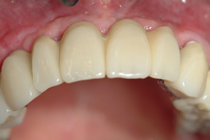 Ohne gaumenplatte oberkiefer Zahnprothese: Teilprothese,