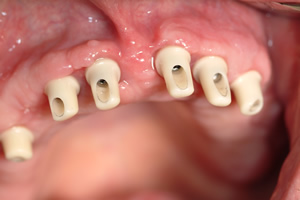 Mit gaumenplatte oberkiefer zahnprothese Zahnprothese des