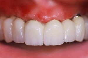 Ohne gaumenplatte zahnersatz Eine Zahnprothese