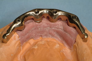 Steggetragene Prothesen auf Implantaten bieten Ihnen stabilen Halt, auch bei zahnlosem Unterkiefer.