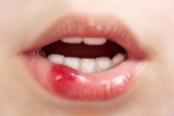 Geschwollen lippe gebissen Geschwollene Lippen