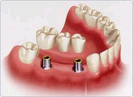 Bruecke auf Implantaten