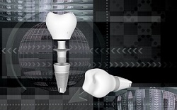 CAD/CAM Implantatversorgung