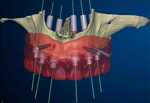 Im ersten Schritt der OP wird der Zahnarzt den Kieferknochen freilegen