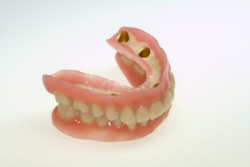 Häufig sind parodontale Vorschäden bei den Kandidaten für eine Cover-Denture-Prothese zu finden. Die restlichen Zähne ermöglichen dennoch einen guten Halt der Prothese.