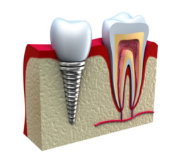 Dentalimplantation