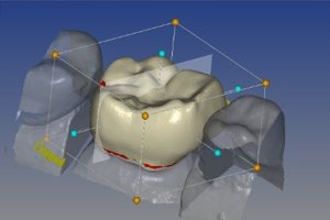 Zahnkrone aus Keramik mit CAD/CAM