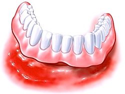 Wenn Zahnprothesen oder Zahnspangen Druck ausüben und so das Zahnfleisch und die Zunge reizen, kann dies ebenfalls zu Schmerzen an der Zunge führen.