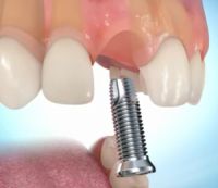 Ist der Zahn nicht zu retten, können Zahnimplantate Abhilfe schaffen.