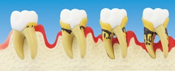 Entwicklung einer Parodontose