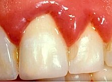 Bakterielle Infektionen des Zahnfleisches