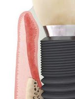 Nach dem Einsetzen eines neuen Zahnimplantats benötigt das Zahnfleisch oft mehrere Wochen, um ganz auszuheilen. Während dieser Periode kann es zu Entzündungen im Bereich des Implantats kommen.