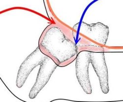 Beim Durchbrechen von Zähnen, wie dem Weisheitszahn oder bei Zahnfehlstellungen können Schmerzen entstehen.