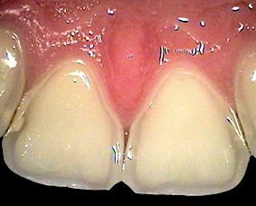 Bei der Zahneriosion löst sich der Zahnschmelz und das Dentin langsam auf. Der Grund sind meist säurhaltige Lebensmittel.