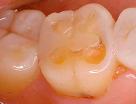 Risse im Dentin können die Folge der Zahnerosion im fortgeschrittenden Stadium sein. Die Auflösung wird verstärkt durch Zähneknirschen.