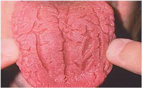 Faltenzunge - Faltenrelief auf der Zunge