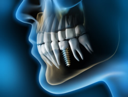 Haltbarkeit eines Implantats