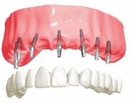 Festsitzende Implantatbrücke für den Oberkiefer