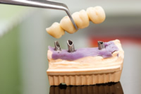 CAD/CAM gefräster Zahnersatz ist besonders präzise an den Unterbau angepasst.