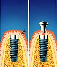 Nach der Einheilphase von mehreren Monaten wird das Implantat freigelegt und das Abutement aufgebracht.