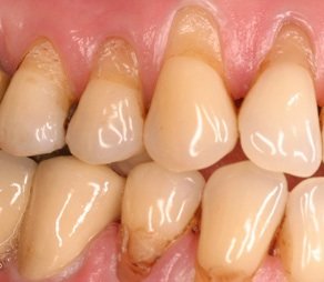 Zahnsensibilität wird ausgelöst durch Zahnfleischrückgang, der z.B. falsches Zähneputzen zur Ursache haben kann.