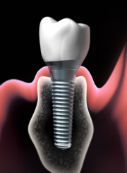 Zahnimplantat Schmerzen haben verschiedene Ursachen