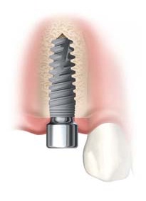 Unter Implantaten versteht man festsitzenden Zahnersatz in Form von künstlichen Zahnwurzeln, die entweder aus reinem oder hochreinem Titan hergestellt werden.
