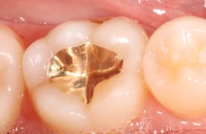 Reparaturen an den Zähnen werden durch die Krankenkassen übernommen, wohingegen rein ästhetische Maßnahmen privat finanziert werden müssen.